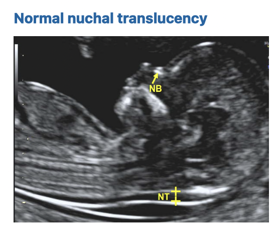 normal-nuchal-translucency